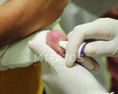 MT Hemocentro atende 599 pacientes com a doen�a falciforme 