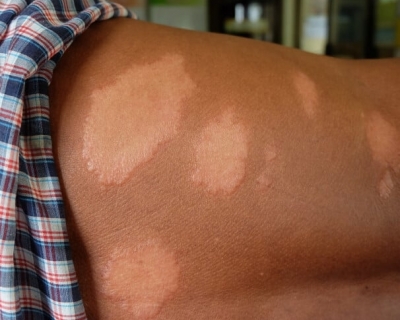 Cuiab� intensifica campanhas de orienta��o e diagn�stico precoce da hansen�ase