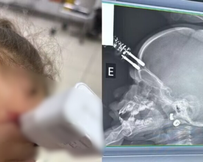 Beb� de 1 ano cai da cama e fica com carregador cravado na testa em Divin�polis