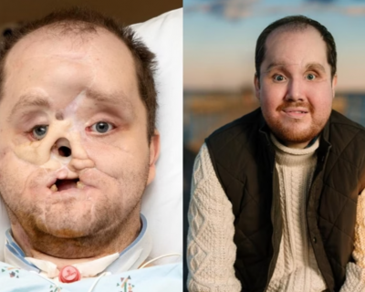 Homem passa por transplante de rosto ap�s anos sem sorrir.