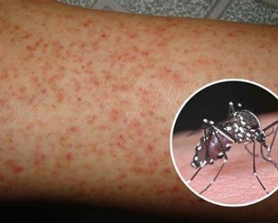 MT tem maior nmero de mortes por dengue em 14 anos