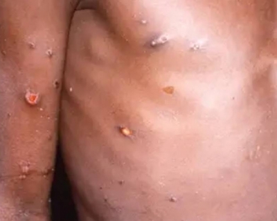 Sade de Mato Grosso monitora casos da doena Mpox