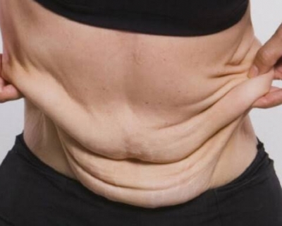 Plano de sade  condenado a custear cirurgia para retirada de pele aps baritrica em Cuiab