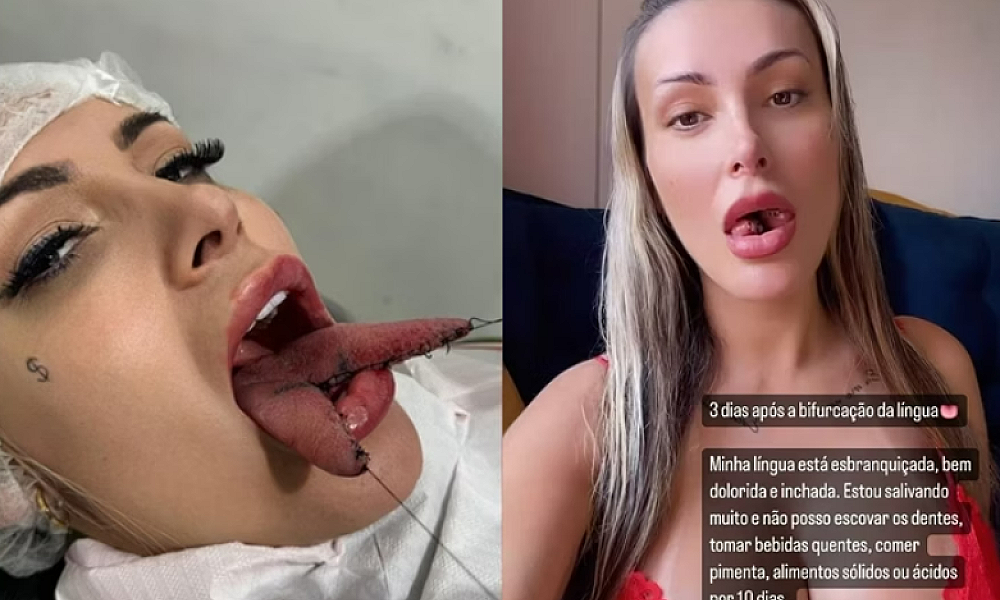Andressa Urach mostra como está a língua no 3º dia após bifurcação