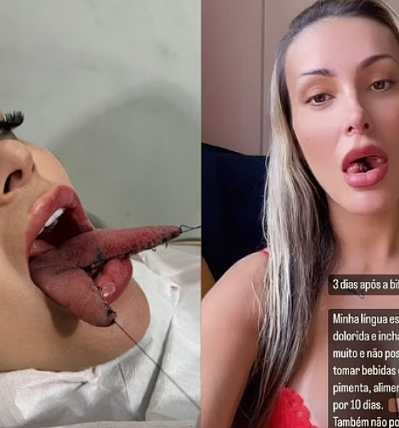 Andressa Urach mostra como está a língua no 3º dia após bifurcação