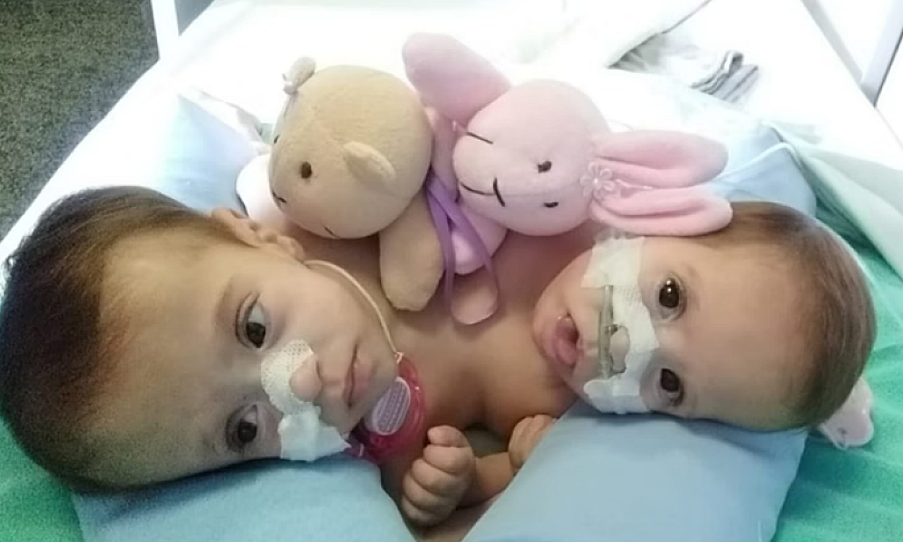 Caso raro: gêmeas siamesas com três pernas deixam hospital pela 1ª vez