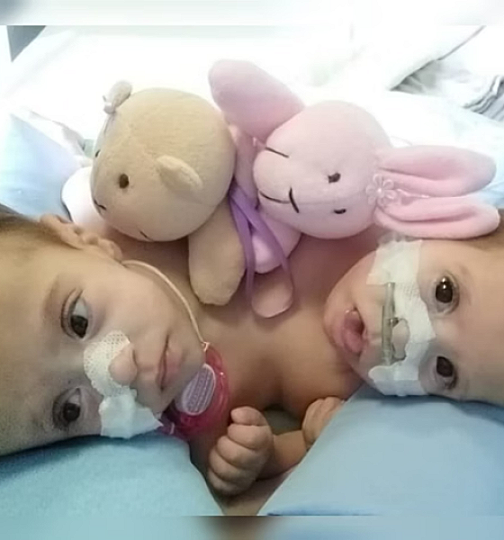 Caso raro: gêmeas siamesas com três pernas deixam hospital pela 1ª vez