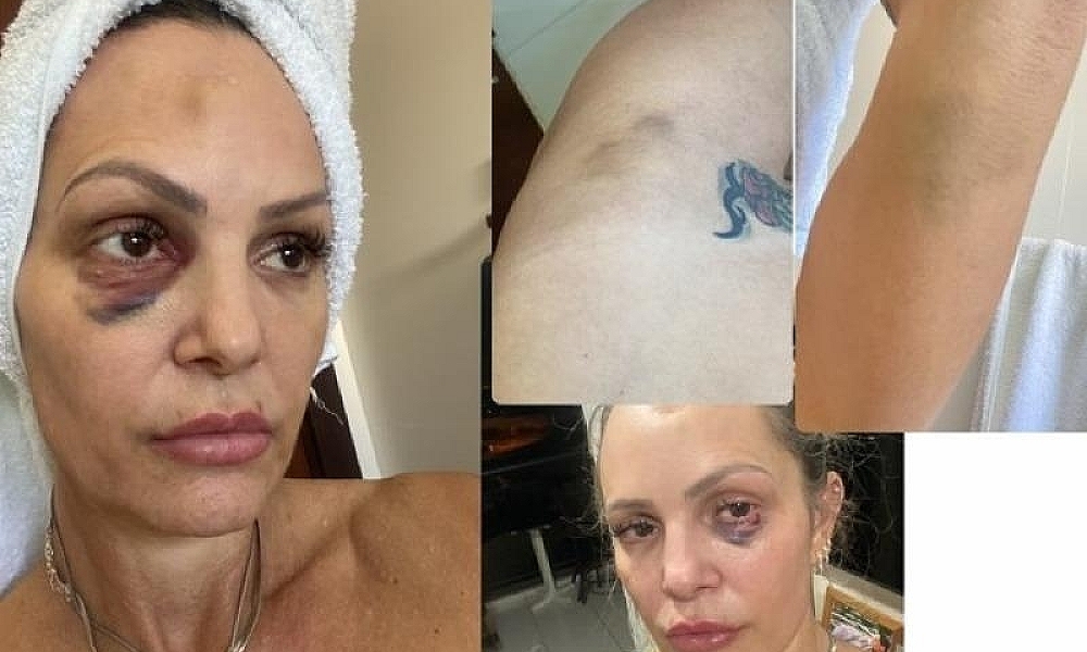 Personal trainer mostra hematomas de agressões sofridas por policial civil