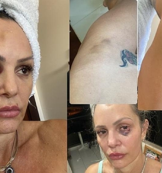 Personal trainer mostra hematomas de agressões sofridas por policial civil