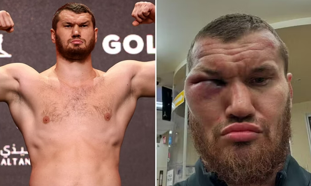 Boxeador russo tem rosto desfigurado após luta. Veja antes e depois