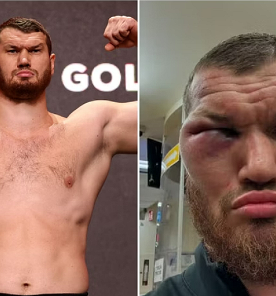 Boxeador russo tem rosto desfigurado após luta. Veja antes e depois