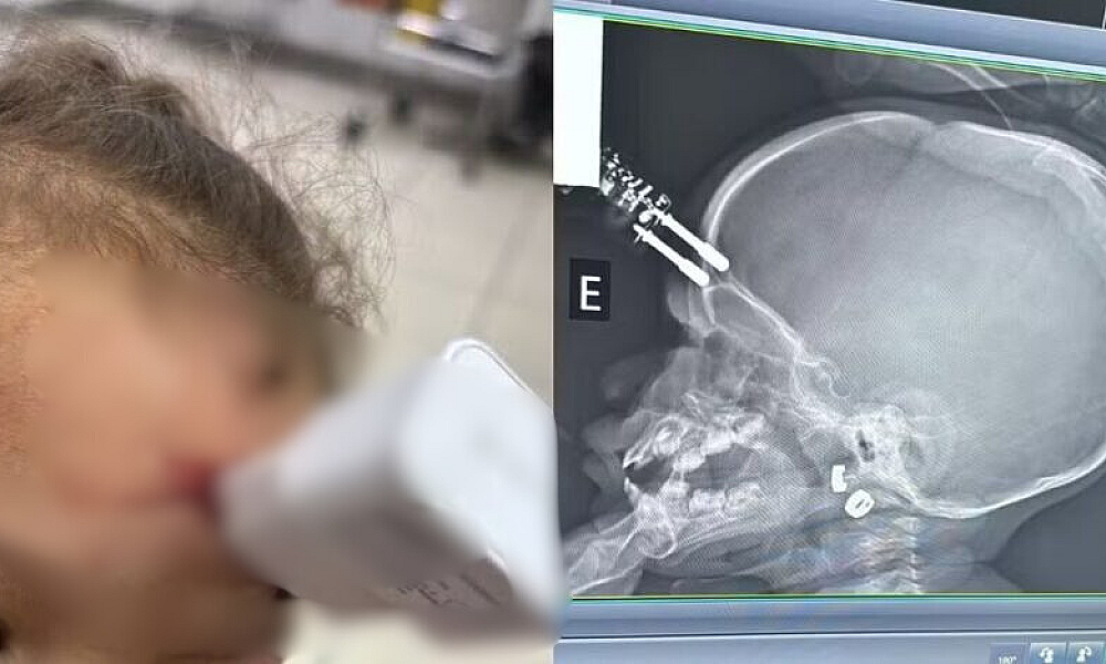 Bebê de 1 ano cai da cama e fica com carregador cravado na testa em Divinópolis