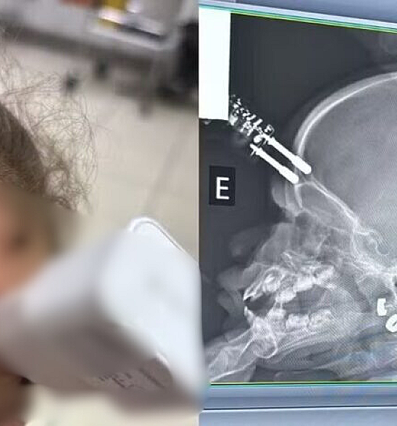 Bebê de 1 ano cai da cama e fica com carregador cravado na testa em Divinópolis