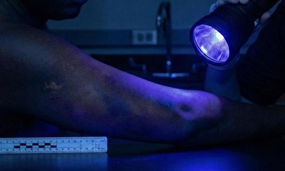 Estudo avalia a eficiência do uso de luzes forenses na detecção de hematomas em pessoas negras