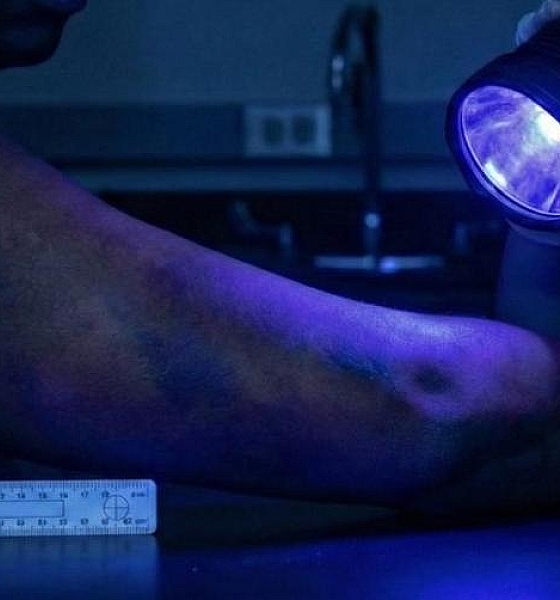 Estudo avalia a eficiência do uso de luzes forenses na detecção de hematomas em pessoas negras