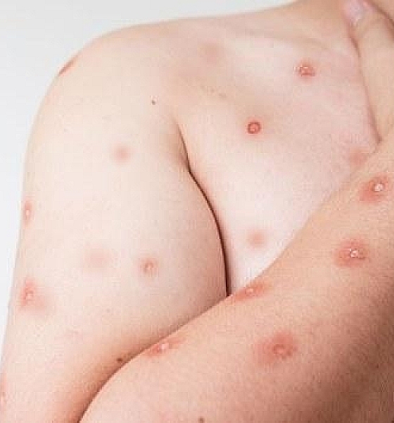 SES alerta para monitoramento de casos de Mpox em MT após avanço de variante em Rondônia