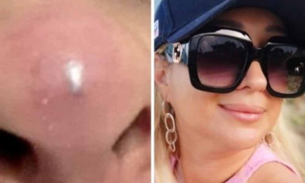 Procedimento estético em Cuiabá termina com suspeita de necrose e denúncia contra biomédica