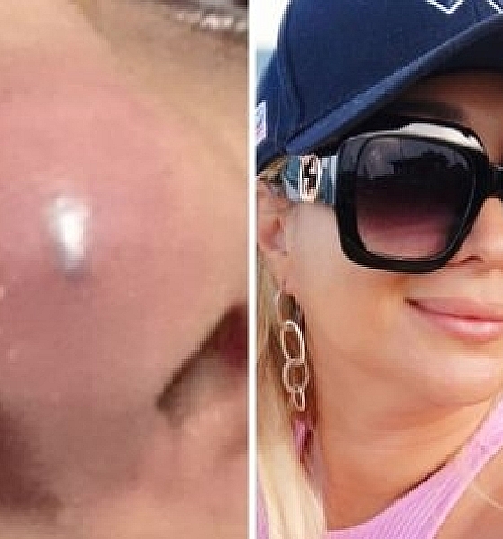 Procedimento estético em Cuiabá termina com suspeita de necrose e denúncia contra biomédica