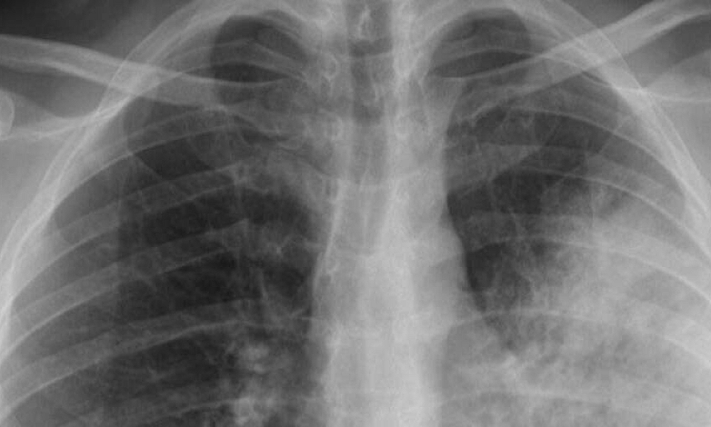 Pneumonia mata e exige atenção: sinais podem começar como uma simples gripe