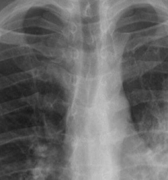 Pneumonia mata e exige atenção: sinais podem começar como uma simples gripe