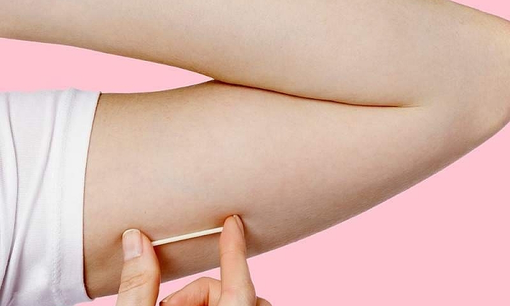 Implanon ganha reforço no SUS com nova etapa de capacitação profissional