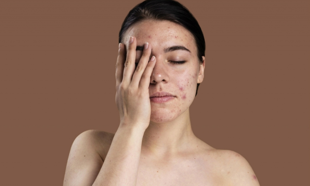 Regulação hormonal: A acne na pele de mulheres maduras