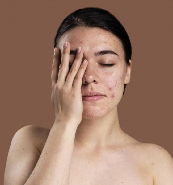 Regulação hormonal: A acne na pele de mulheres maduras