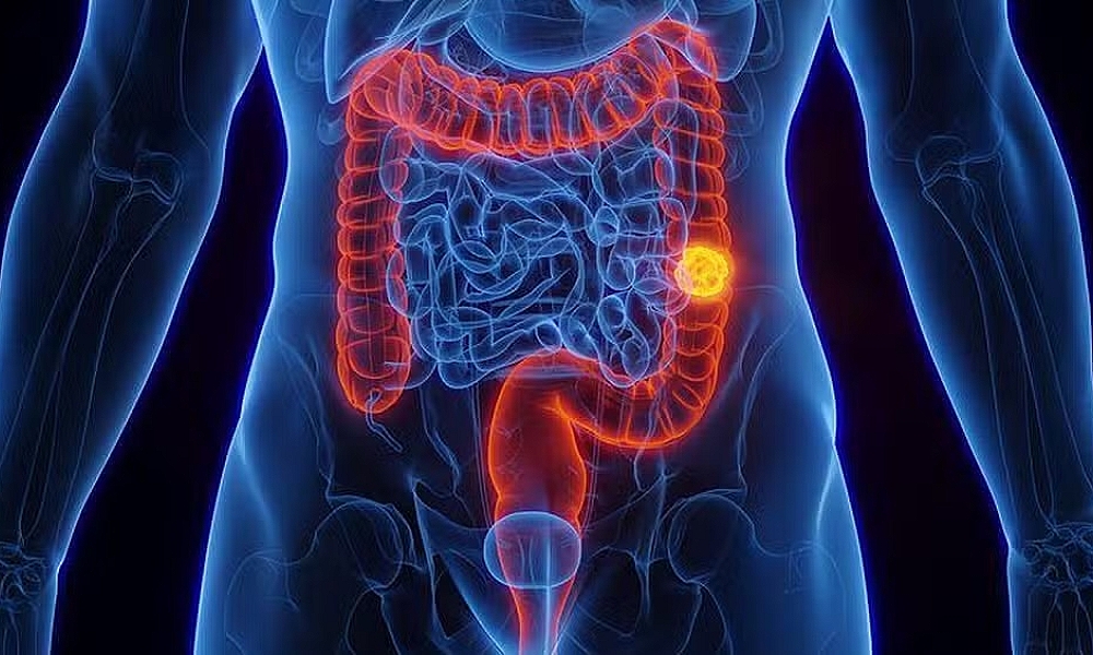 Aumento alarmante do câncer colorretal em pessoas com menos de 50 anos preocupa especialistas
