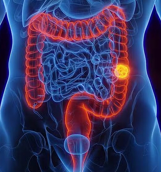 Aumento alarmante do câncer colorretal em pessoas com menos de 50 anos preocupa especialistas