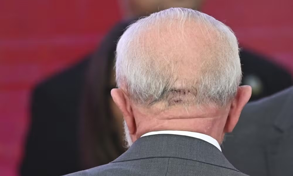 “Lula é internado e passa por cirurgia de emergência para drenagem de hematoma cerebral”