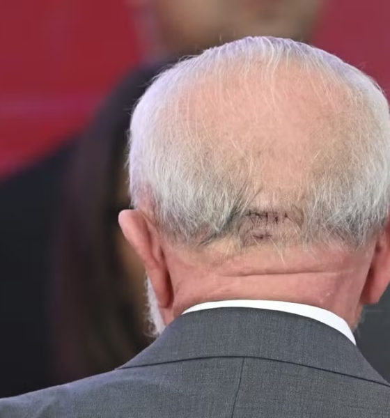 “Lula é internado e passa por cirurgia de emergência para drenagem de hematoma cerebral”