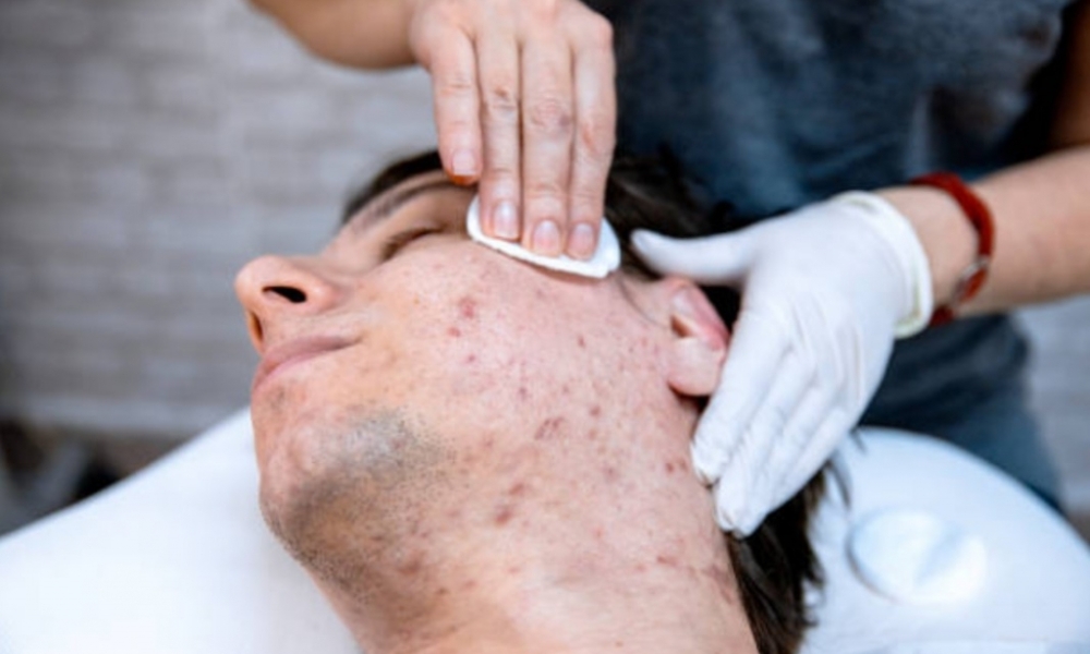 Controle da acne e oleosidade: descubra os tratamentos mais indicados para pele masculina