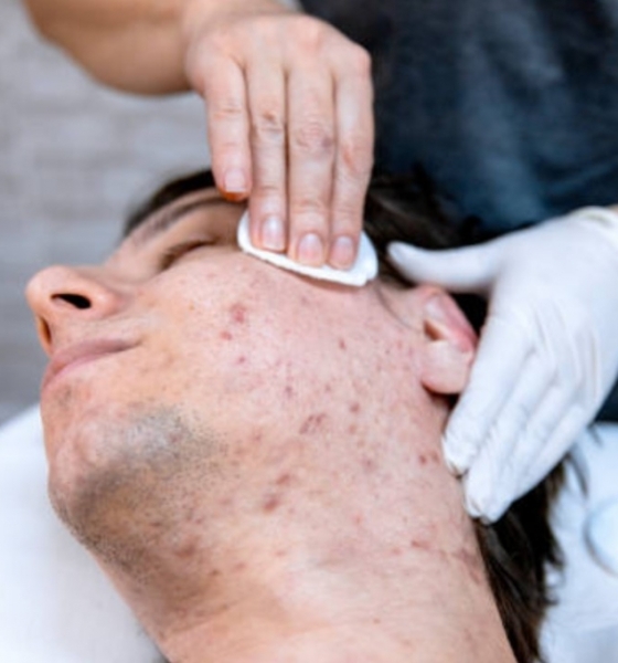 Controle da acne e oleosidade: descubra os tratamentos mais indicados para pele masculina
