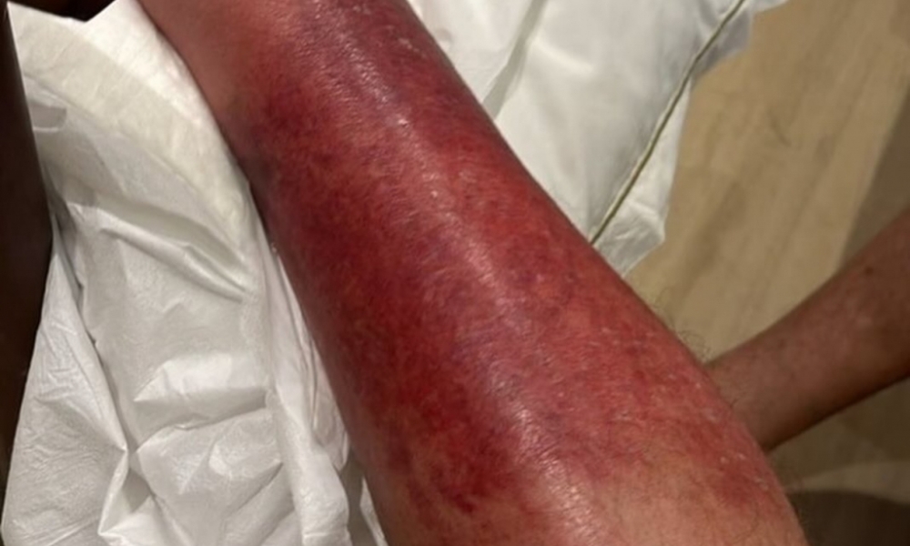 Melhora no Estado de Saúde de Jair Bolsonaro: Ex-Presidente Combate Erisipela com Sucesso