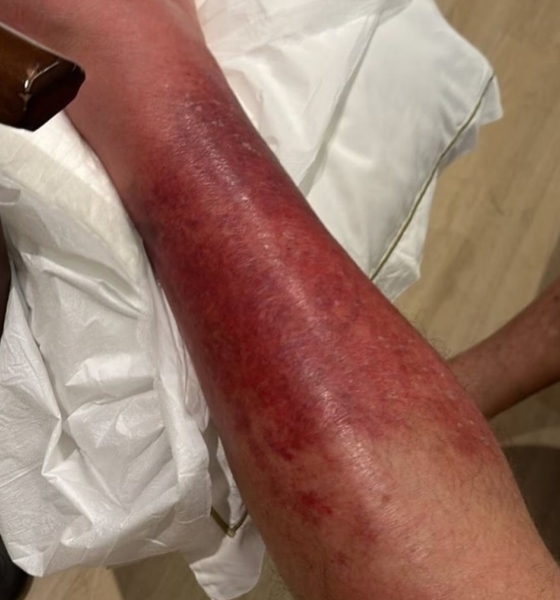 Melhora no Estado de Saúde de Jair Bolsonaro: Ex-Presidente Combate Erisipela com Sucesso