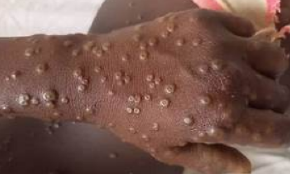 Ministério da Saúde confirma primeiro caso da cepa 1b da mpox no Brasil