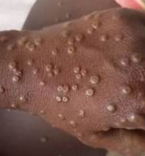 Ministério da Saúde confirma primeiro caso da cepa 1b da mpox no Brasil