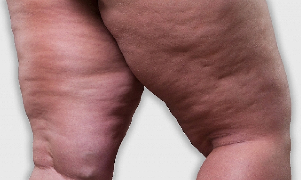 Lipedema: A Doença Silenciosa que Afeta Milhares de Mulheres