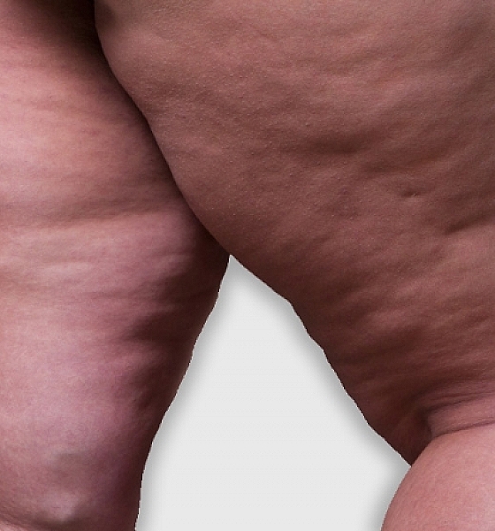Lipedema: A Doença Silenciosa que Afeta Milhares de Mulheres