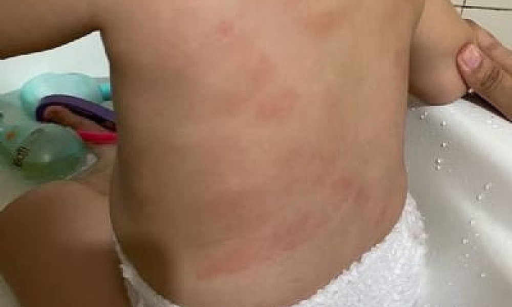 Laudo confirma que bebê de 1 ano foi agredido em creche