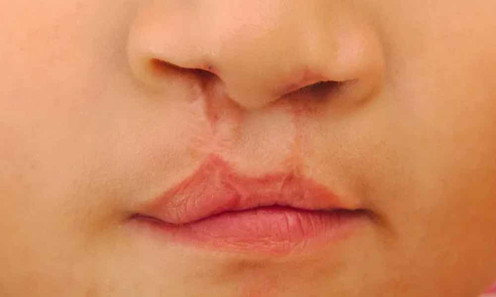 Lula sanciona lei que obriga SUS a ofertar cirurgia de lábio leporino