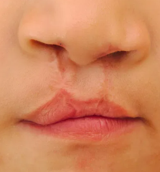 Lula sanciona lei que obriga SUS a ofertar cirurgia de lábio leporino