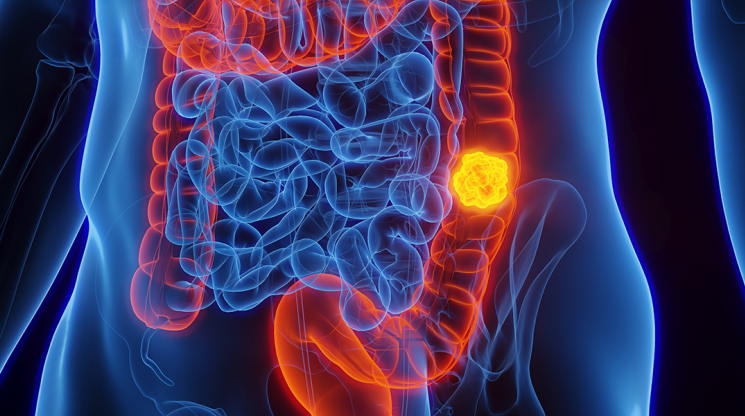  Brasil pode registrar aumento de 36% nas mortes por c�ncer colorretal at� 2040