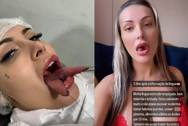 Andressa Urach mostra como est� a l�ngua no 3� dia ap�s bifurca��o