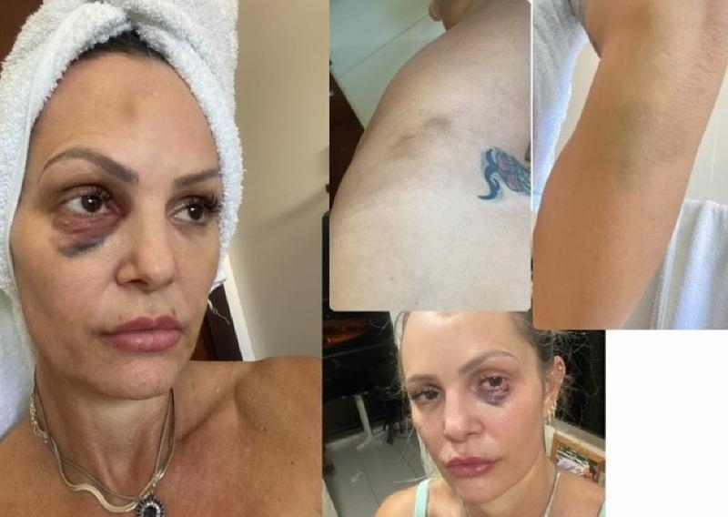 Personal trainer mostra hematomas de agress�es sofridas por policial civil