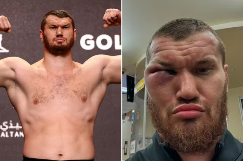 Boxeador russo tem rosto desfigurado ap�s luta. Veja antes e depois