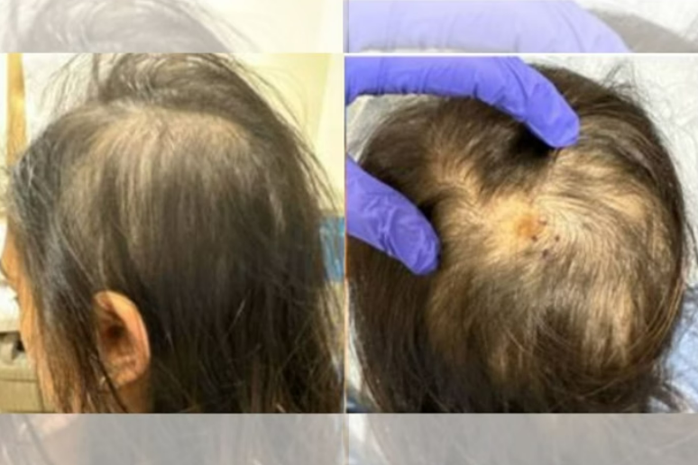 Mulher de 28 anos perde parte do cabelo ap�s ser picada por carrapato