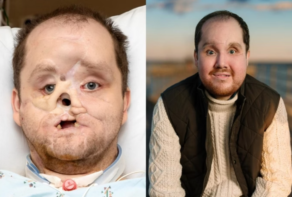 Homem passa por transplante de rosto ap�s anos sem sorrir.