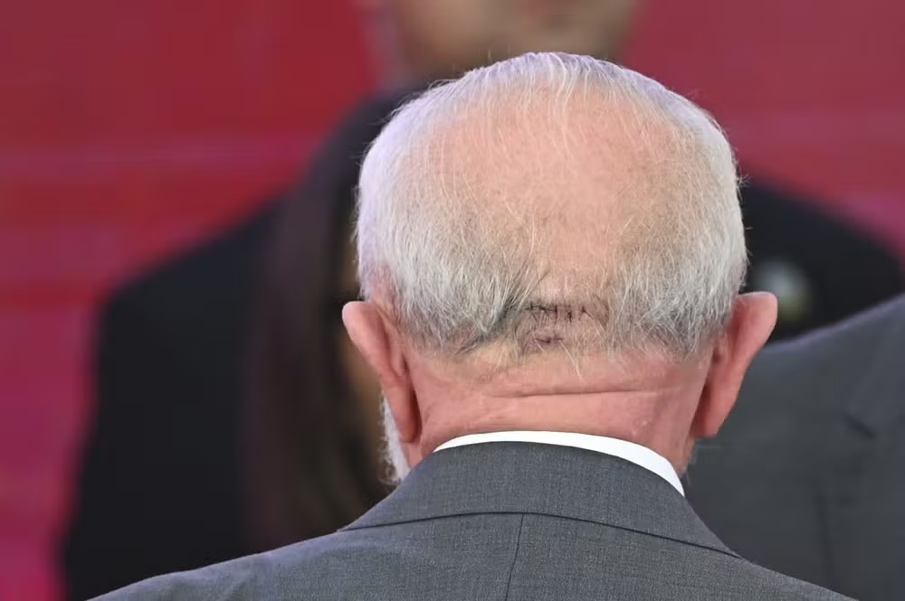 �Lula � internado e passa por cirurgia de emerg�ncia para drenagem de hematoma cerebral�