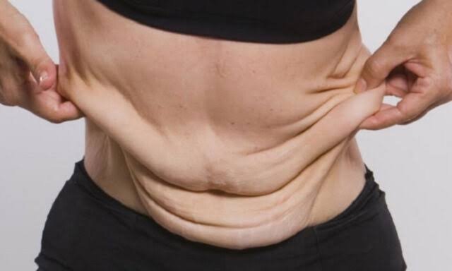 Plano de sa�de � condenado a custear cirurgia para retirada de pele ap�s bari�trica em Cuiab�